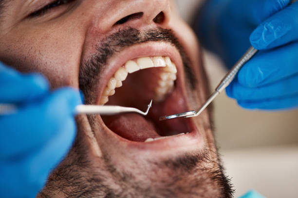 Best Knocked-Out Tooth (Avulsed Tooth) Treatment in Yardville, NJ